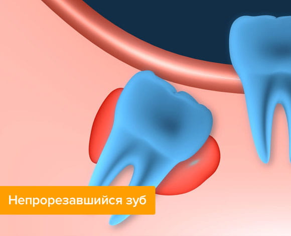 Непрорезавшийся зуб мудрост