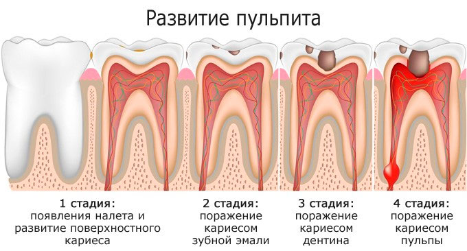 Лечение пульпита Лечение пульпита