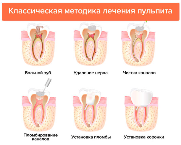Методы лечения пульпита Методы лечения пульпита